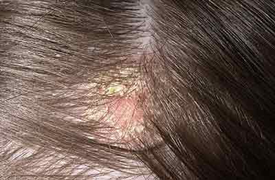 Grapeseed Oil treats Dandruff