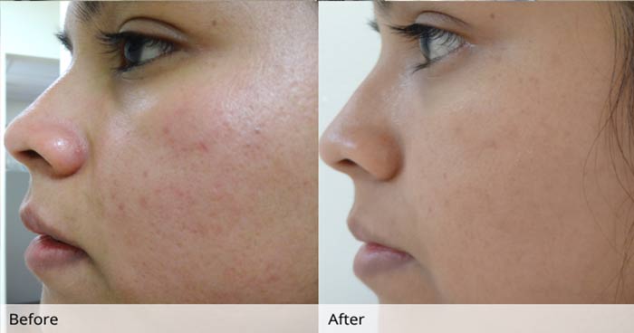 before and after results olive oil skin acne review