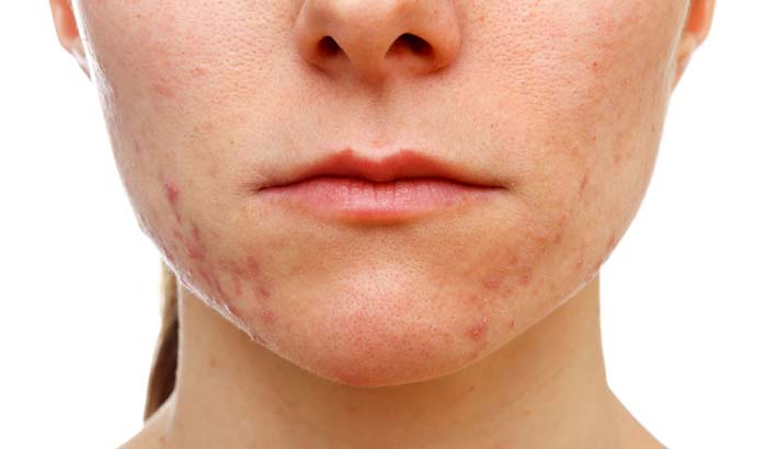 can-oil cause-acne bad foracne
