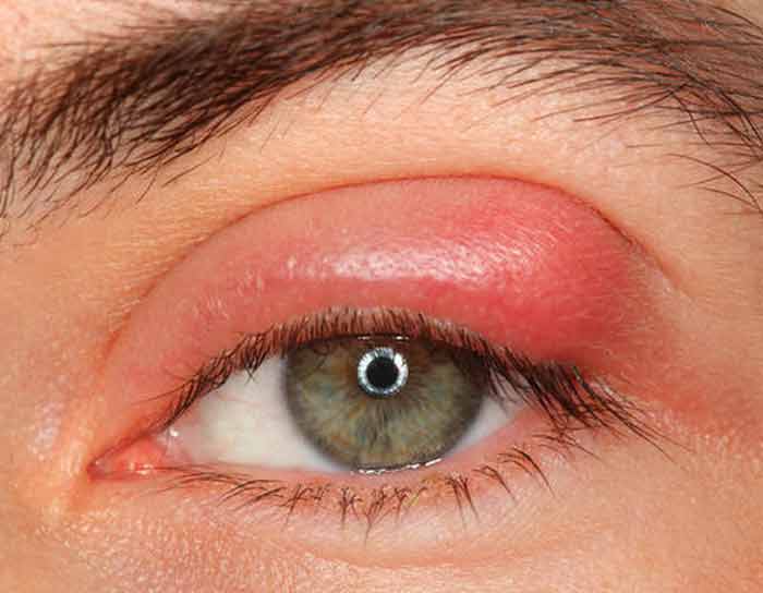 Eyelid swelling ingrown eyelash symptom
