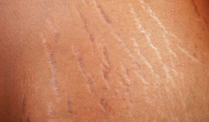 Grape seed oil can help cure stretch marks