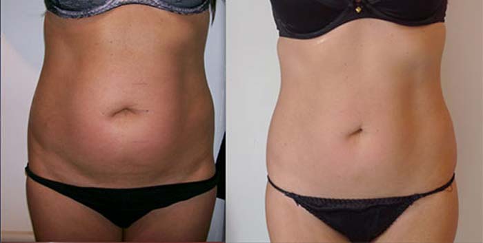 Black cumin seed oil before and after belly fat loss results