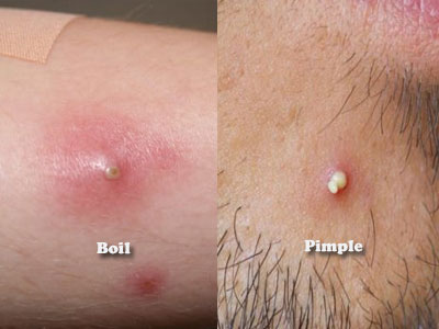 Boil vs Pimple- differences