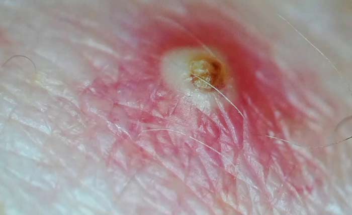 Infectected ingrown hair breast nipple
