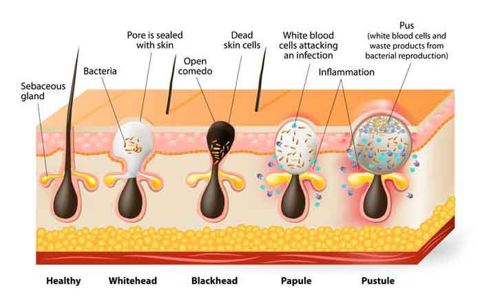 Types of pimples and symptoms