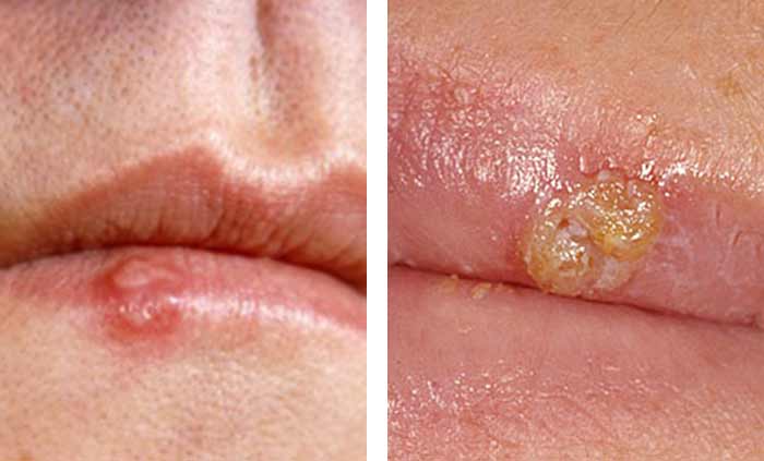 acne/pimple vs cold sore pictures
