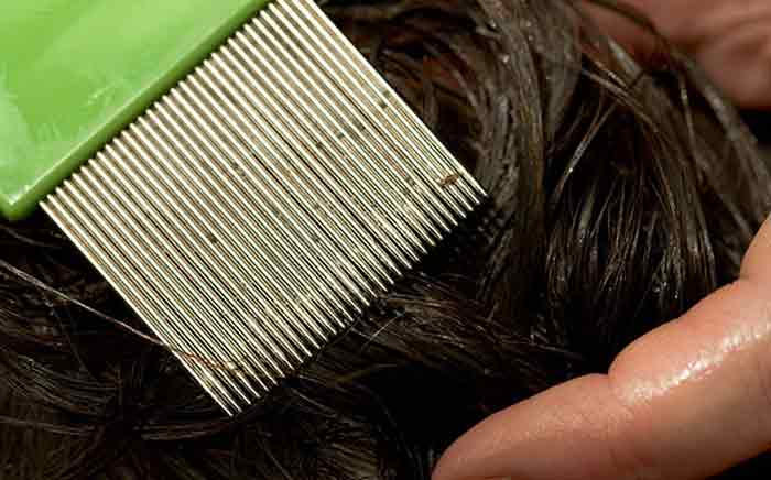 How To Tell If You Have Lice Without Comb 