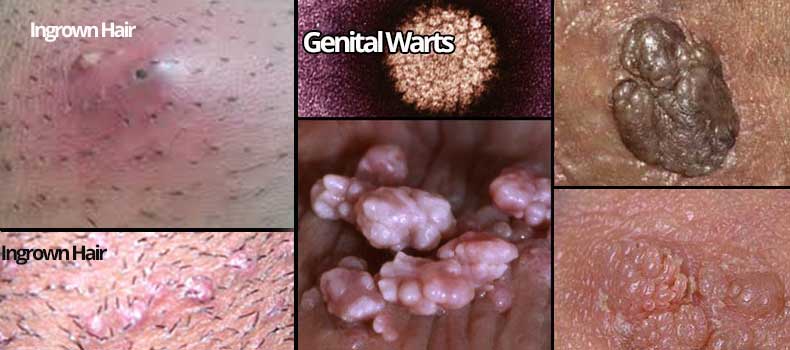 ingrown hair vs genital warts herpes std pictures