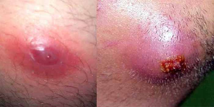 pictures ingrown hair cyst deep and infected