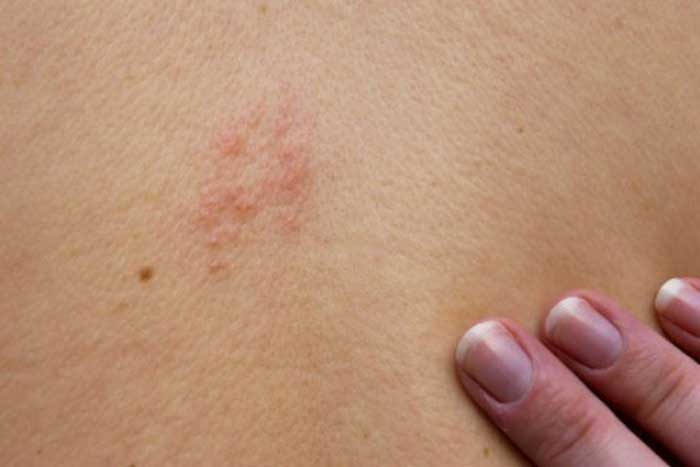 How lond does shingles last with or without treatment?