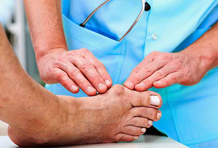 how get rid shrink reverse bunions without surgery naturally