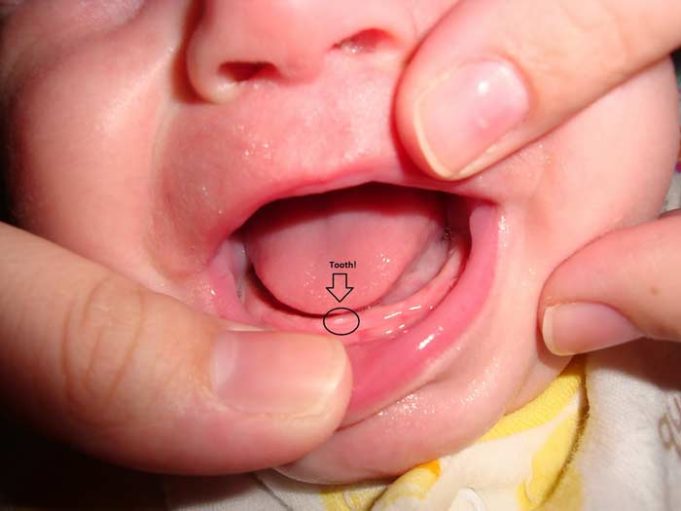 White Spots on Gums Baby, Painful, Pictures, Above, Below Teeth, Hard