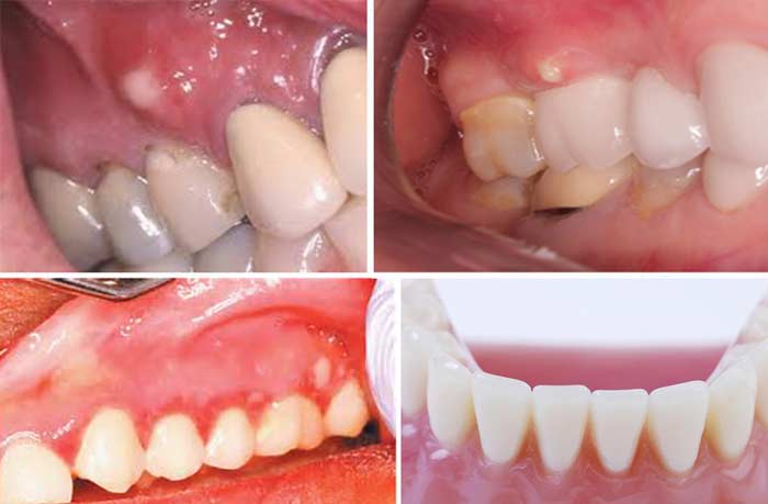 white spots on gums pictures
