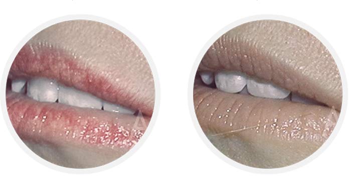 before-after-treatment-fordyce-spots