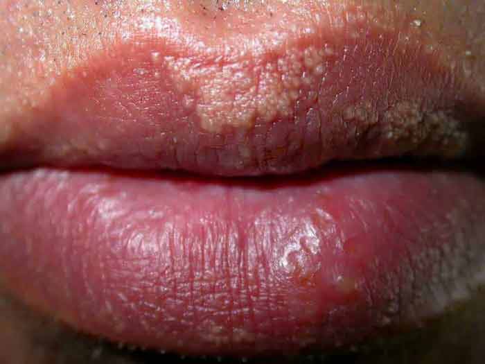 fordyce spots on lips upper lower