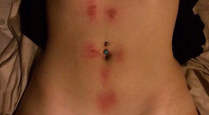 picture of a hickey stomach