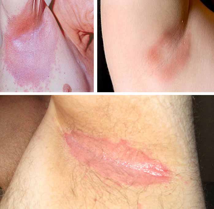 armpit rash pictures