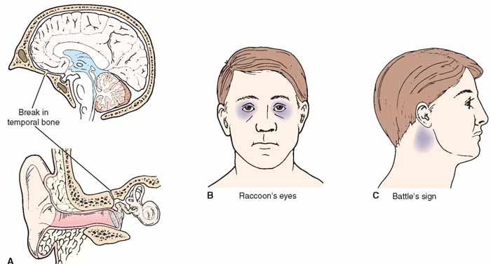 battle sign vs raccoon eye