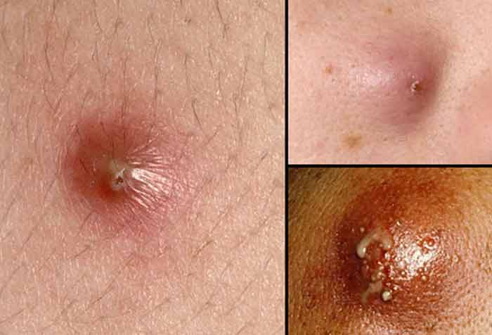 infected pimple pictures-causes, symptoms-treat