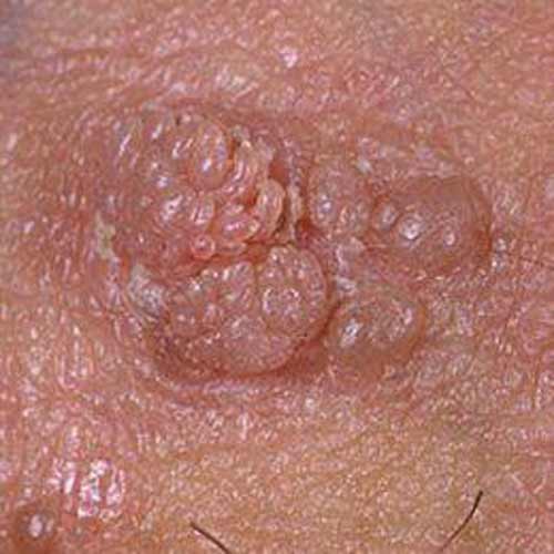 picture of penile eczema