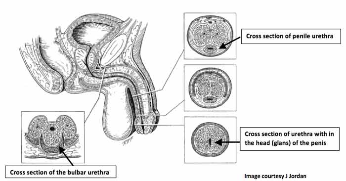 urethral stricture male